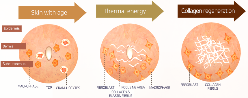Collagen regeneration principle