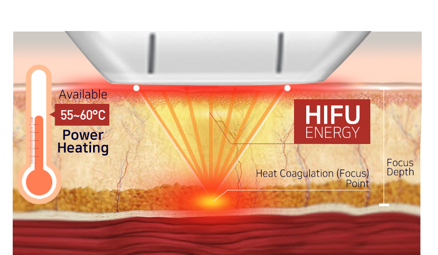 HIFU treatment theory